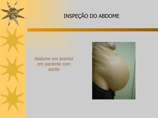 Abdome em avental em paciente com ascite INSPEÇÃO DO ABDOME 