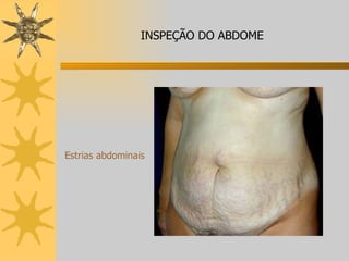 Estrias abdominais INSPEÇÃO DO ABDOME 