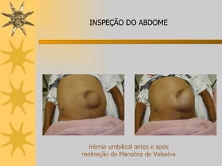 Hérnia umbilical antes e após realização da Manobra de Valsalva INSPEÇÃO DO ABDOME 