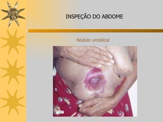 Nódulo umbilical INSPEÇÃO DO ABDOME 