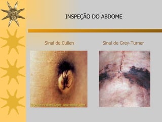 Sinal de Grey-Turner INSPEÇÃO DO ABDOME Sinal de Cullen 