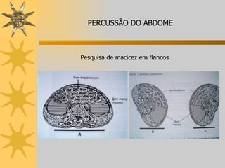 PERCUSSÃO DO ABDOME Pesquisa de macicez em flancos 
