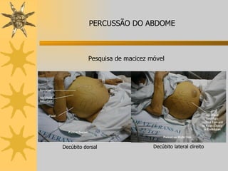 Pesquisa de macicez móvel Decúbito dorsal Decúbito lateral direito PERCUSSÃO DO ABDOME 