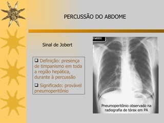 Definição: presença de timpanismo em toda a região hepática, durante à percussão Significado: provável pneumoperitônio Sinal de Jobert Pneumoperitônio observado na radiografia de tórax em PA PERCUSSÃO DO ABDOME 