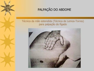 Técnica da mão estendida (Técnica de Lemos-Torres) para palpação do fígado PALPAÇÃO DO ABDOME 