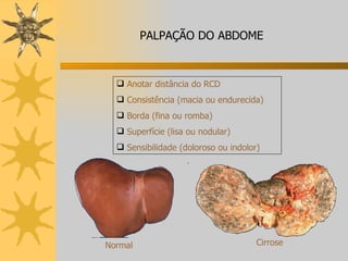 Anotar distância do RCD Consistência (macia ou endurecida) Borda (fina ou romba) Superfície (lisa ou nodular) Sensibilidade (doloroso ou indolor) Normal Cirrose PALPAÇÃO DO ABDOME 