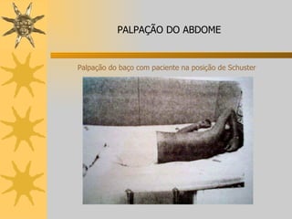 Palpação do baço com paciente na posição de Schuster PALPAÇÃO DO ABDOME 
