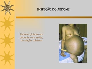 Abdome globoso em paciente com ascite, circulação colateral INSPEÇÃO DO ABDOME 