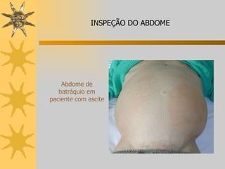 Abdome de batráquio em paciente com ascite INSPEÇÃO DO ABDOME 