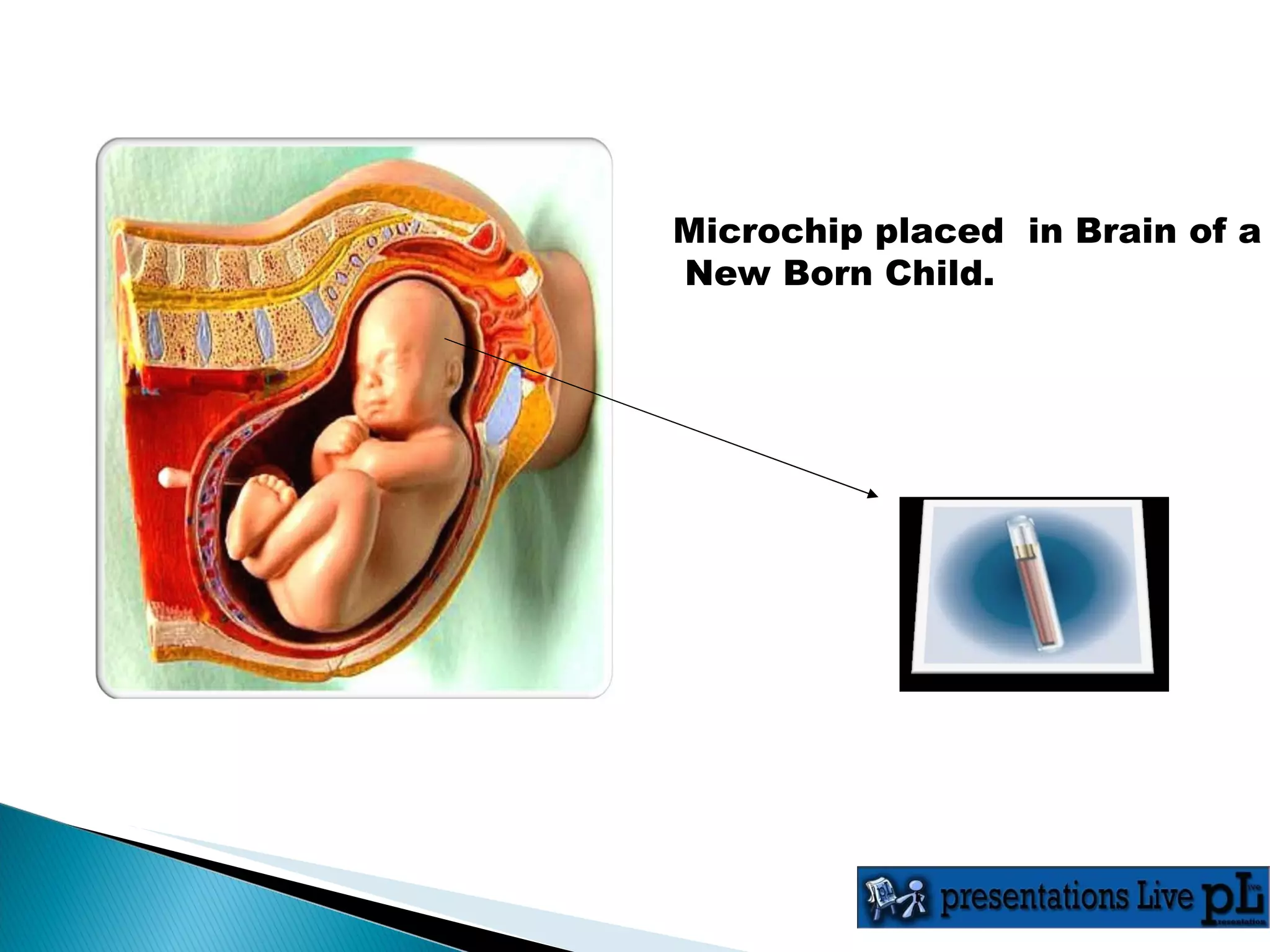 Microchip placed  in Brain of a  New Born Child. 