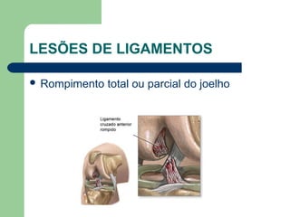 LESÕES DE LIGAMENTOS
 Rompimento total ou parcial do joelho
 