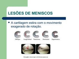 LESÕES DE MENISCOS
 A cartilagem estira com o movimento
exagerado de rotação.
 