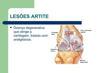 LESÕES ARTITE
 Doença degenerativa
que atinge a
cartilagem, tratada com
analgésicos.
 
