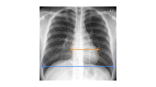 CHEST RADIOGRAPH REVIEW EXPLAINED...pptx