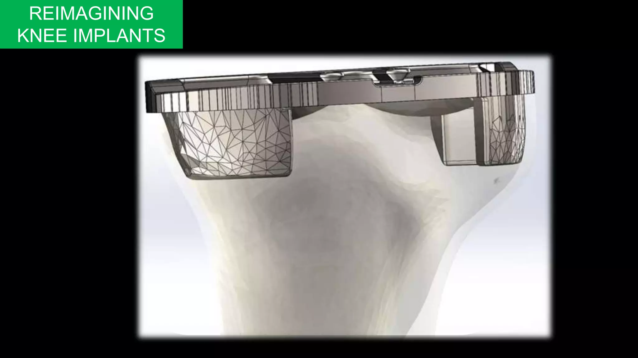 REIMAGINING
KNEE IMPLANTS
 