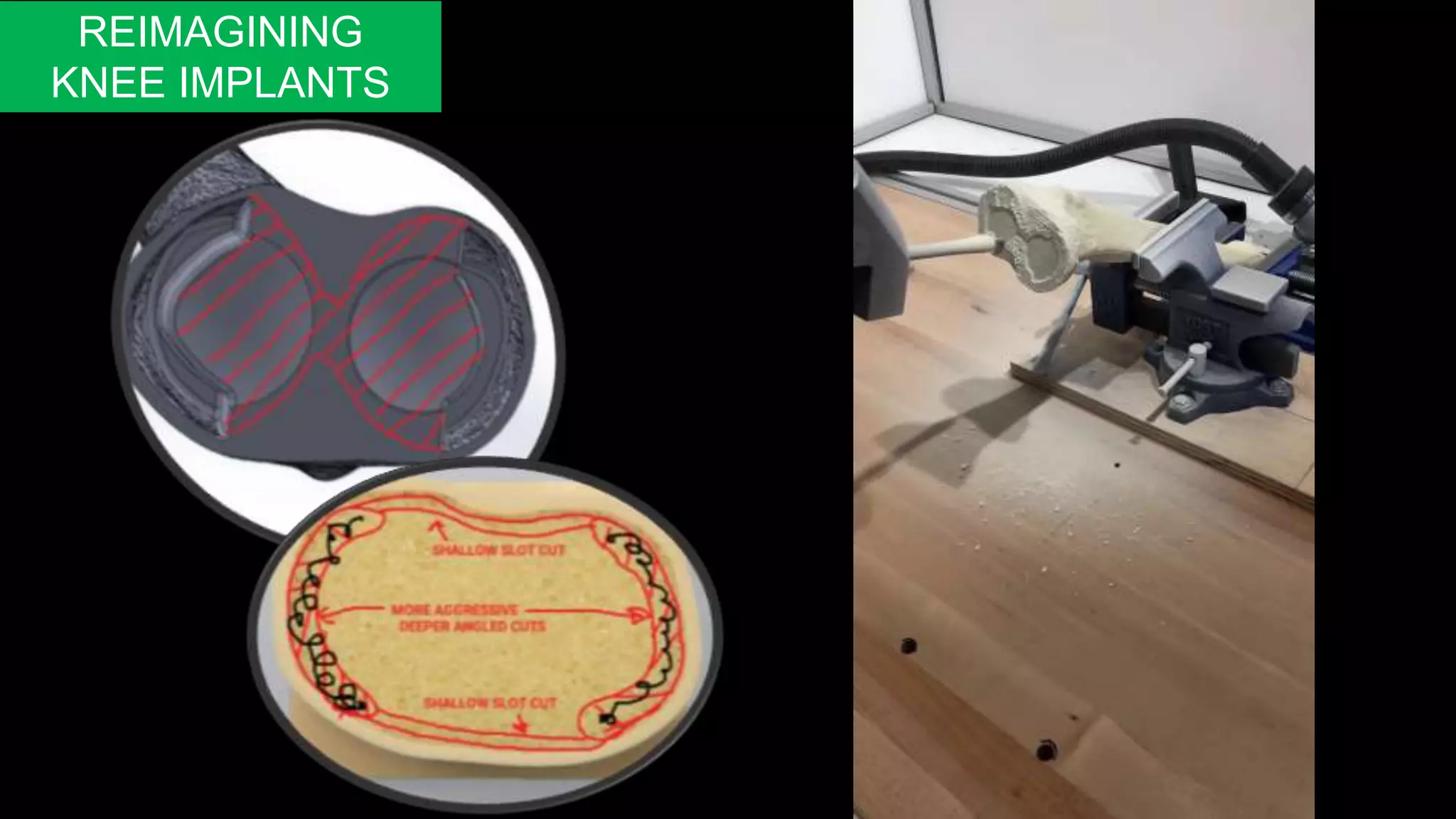 REIMAGINING
KNEE IMPLANTS
 