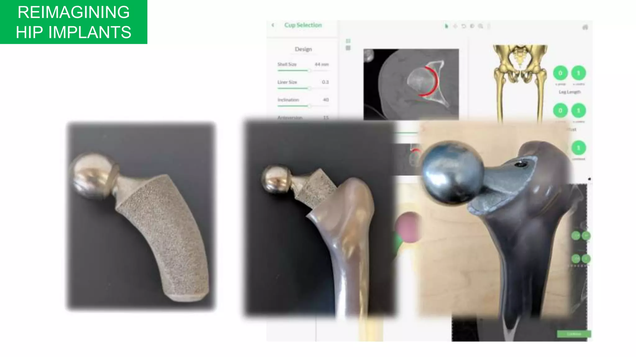 REIMAGINING
HIP IMPLANTS
 