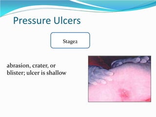 Pressure Ulcers
Stage2
abrasion, crater, or
blister; ulcer is shallow
 