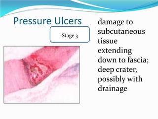 Pressure Ulcers
Stage 3
damage to
subcutaneous
tissue
extending
down to fascia;
deep crater,
possibly with
drainage
 