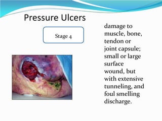 Pressure Ulcers
Stage 4
damage to
muscle, bone,
tendon or
joint capsule;
small or large
surface
wound, but
with extensive
tunneling, and
foul smelling
discharge.
 