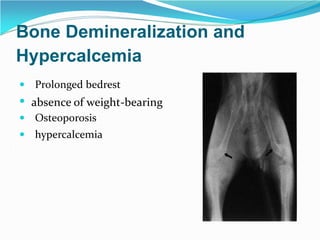 Bone Demineralization and
Hypercalcemia
 Prolonged bedrest
 absence of weight-bearing
 Osteoporosis
 hypercalcemia
 
