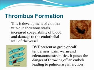 Thrombus Formation
This is development of clot in a
vein due to venous stasis,
increased coagulability of blood
and damage to the endothelial
wall of the vessel
DVT present as groin or calf
tenderness, pain, warm and
edematous extremities. It poses the
danger of throwing off an emboli
leading to pulmonary infarction
 