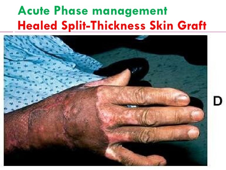 three stages of skin graft healing