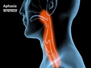 Aphasia
िाचाघात
 