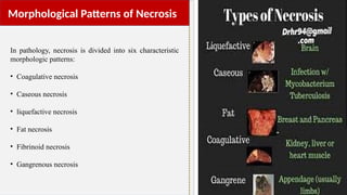 Noncaseating Necrosis Unit-4 Trauma and Cell Injury pathophysiology.pptx