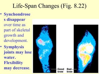 Life-Span Changes (Fig. 8.22) Synchondroses disappear  over time as part of skeletal growth and development. Symphysis joints may lose water. Flexibility   may decrease . 