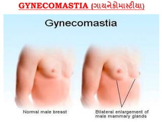 GYNECOMASTIA (ગાયનેકોમાસ્ટીયા)
 