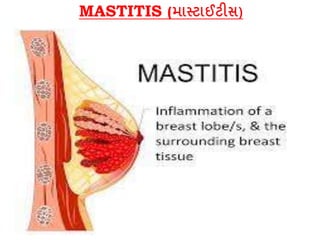 MASTITIS (માસ્ટાઈટીસ)
 