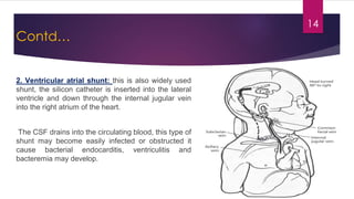 Congenital malformations of the central nervous system | PDF