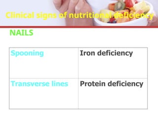 Clinical signs of nutritional deficiency
NAILS
Spooning Iron deficiency
Transverse lines Protein deficiency
 
