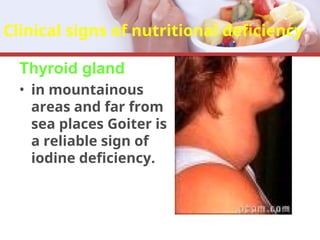 Clinical signs of nutritional deficiency
Thyroid gland
• in mountainous
areas and far from
sea places Goiter is
a reliable sign of
iodine deficiency.
 