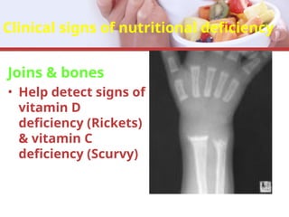 Clinical signs of nutritional deficiency
Joins & bones
• Help detect signs of
vitamin D
deficiency (Rickets)
& vitamin C
deficiency (Scurvy)
 