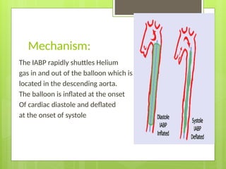 Comprehensive Overview of Intra-Aortic Balloon Pump (IABP) in Cardiac ...