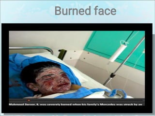 Burned face
 
