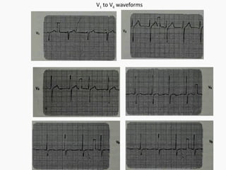 Medical electronics- Bio signal, Electrode, ECG, EEG, PCG | PPT