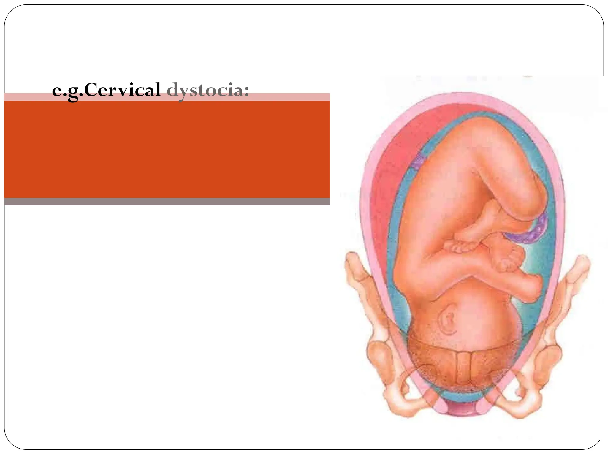 2) SOFT TISSUE OBSTRUCTION
e.g.Cervical dystocia:
 