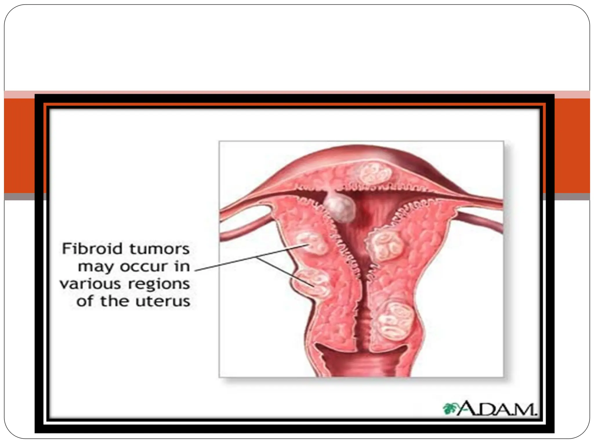 e.g.Cervical or broad ligament fibroid
 