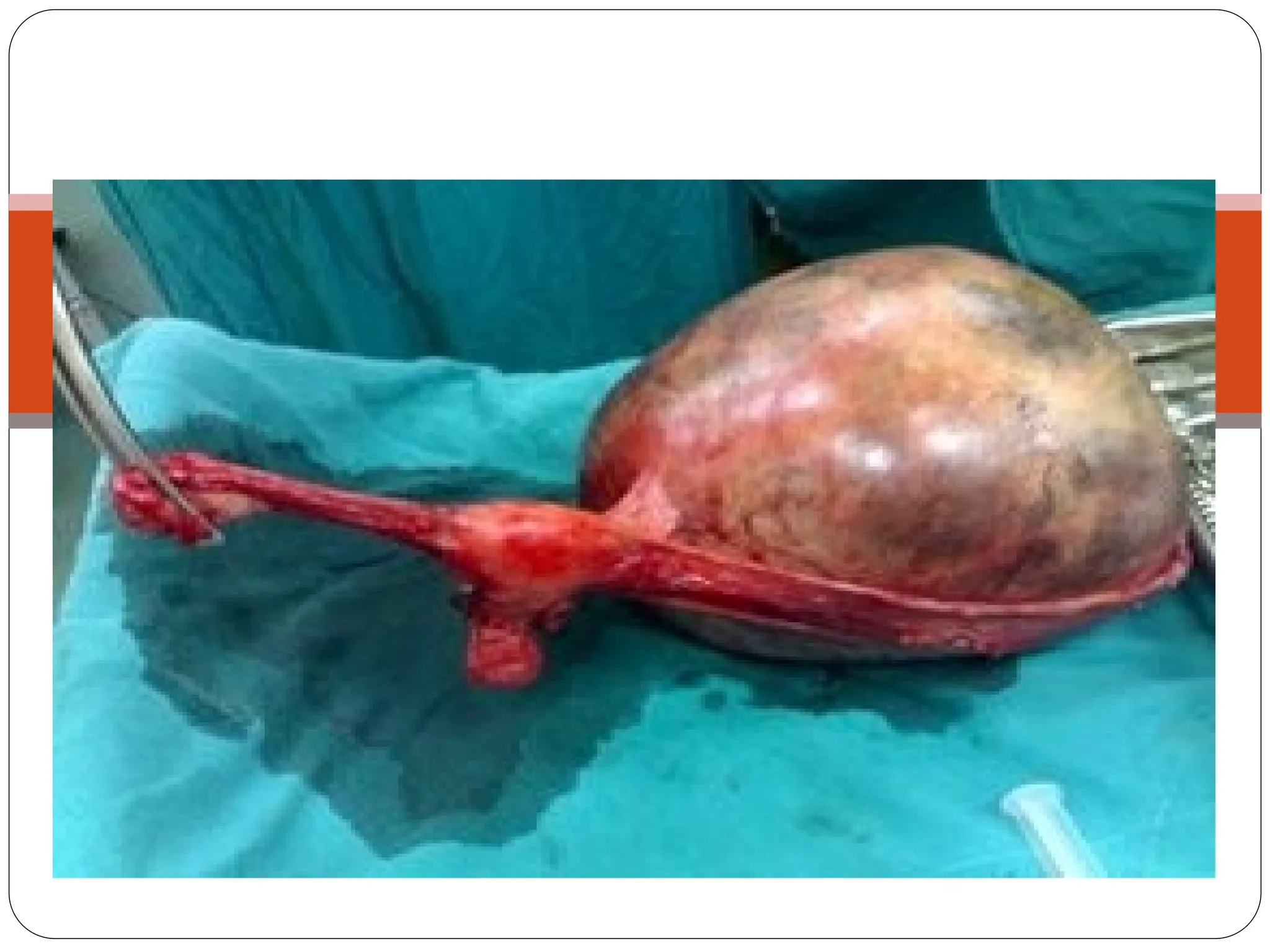 e.g. Impacted ovarian tumor
 