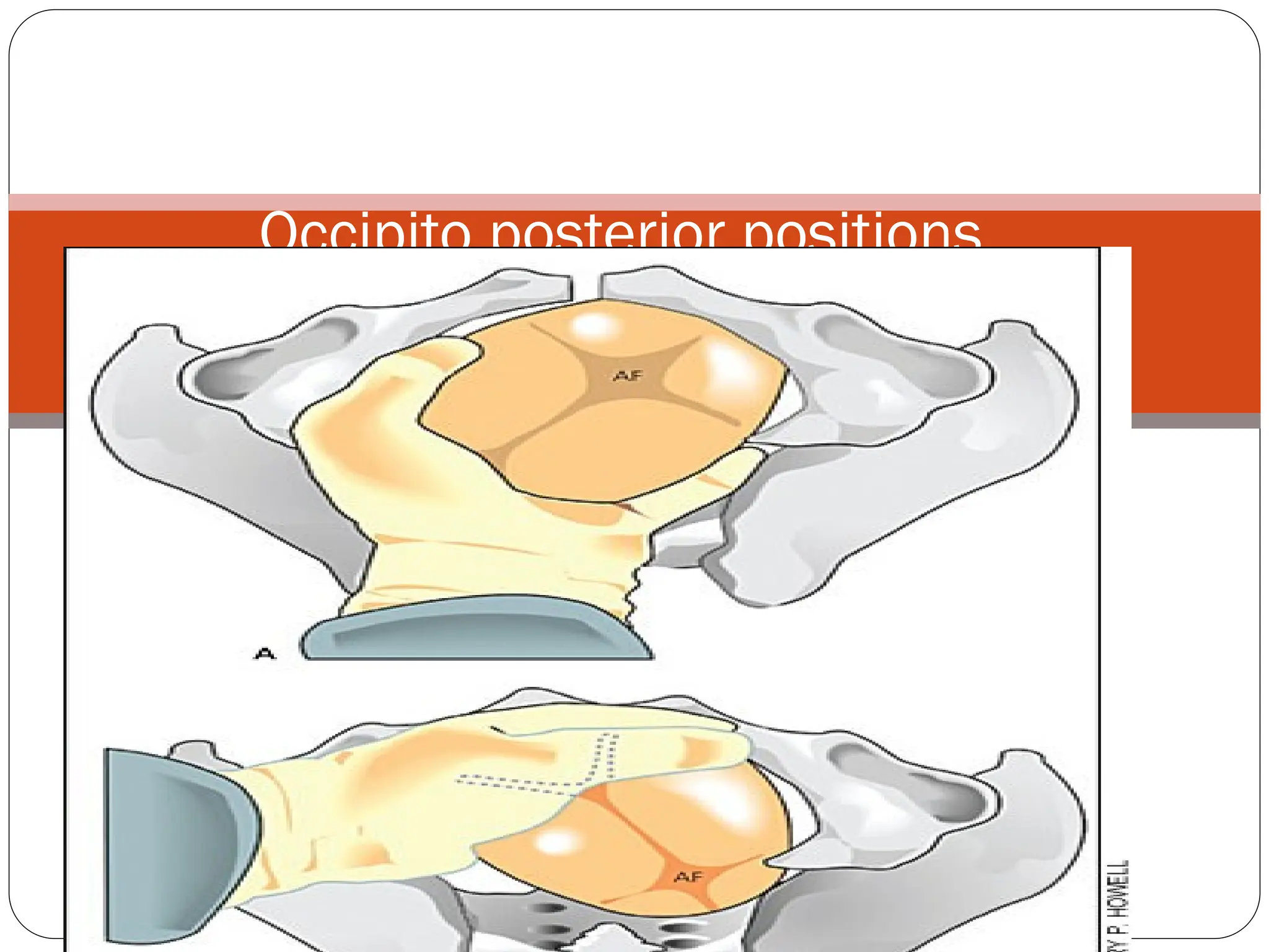 Occipito posterior positions.
 
