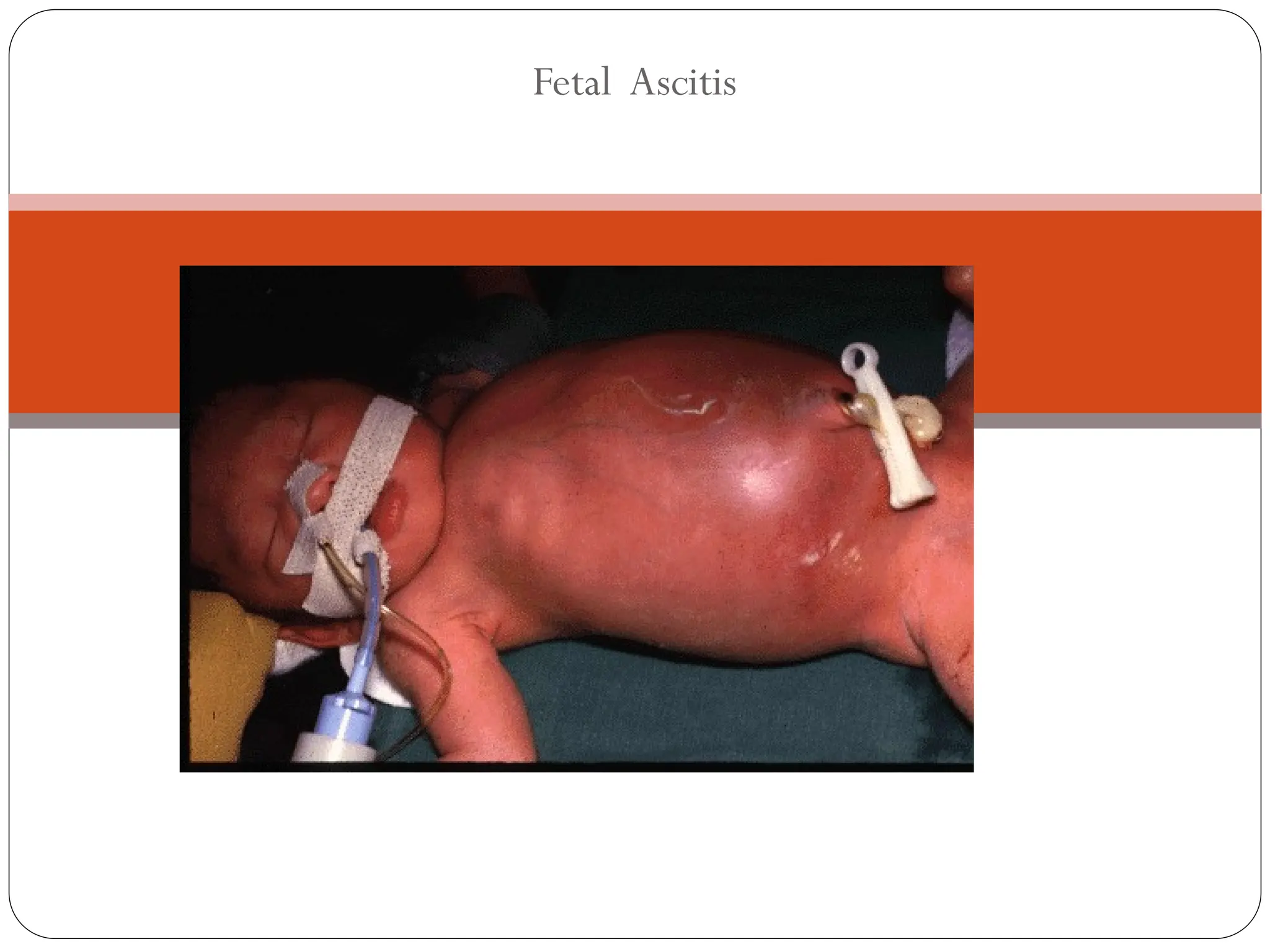 Fetal Ascitis
 