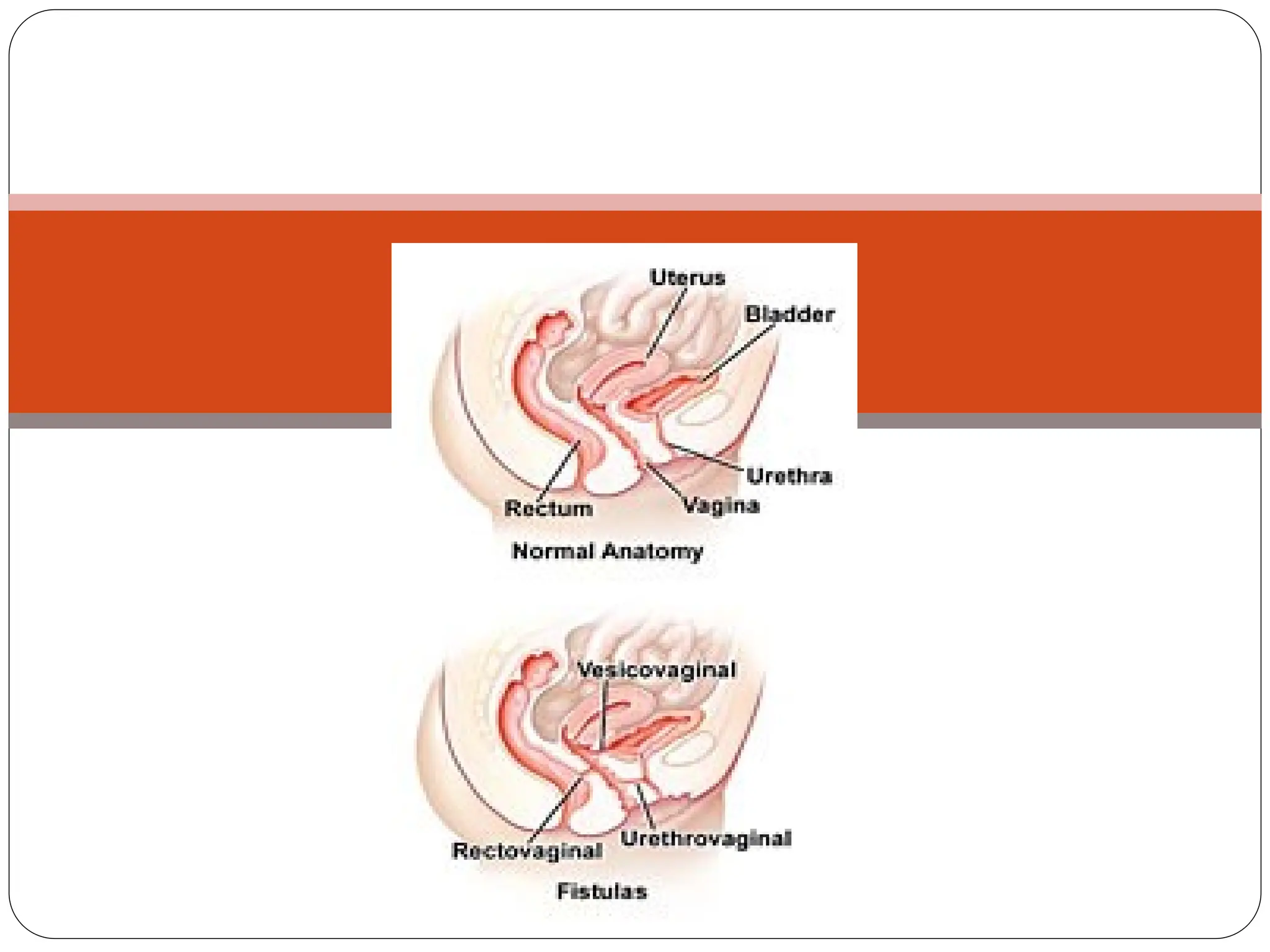 Genito urinary Fistula
 