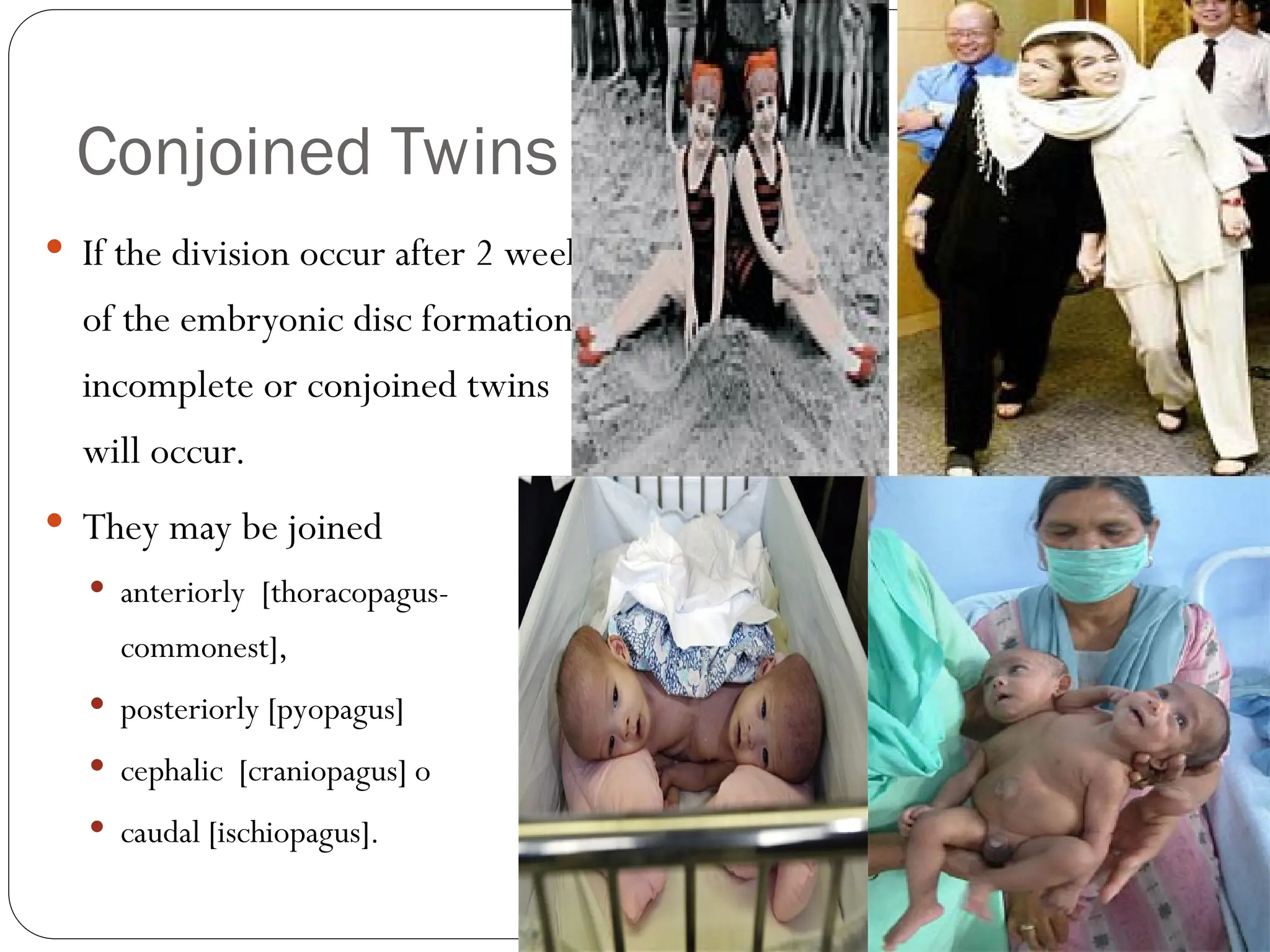 Conjoined Twins
 If the division occur after 2 weeks
of the embryonic disc formation,
incomplete or conjoined twins
will occur.
 They may be joined
 anteriorly [thoracopagus-
commonest],
 posteriorly [pyopagus]
 cephalic [craniopagus] o
 caudal [ischiopagus].
 