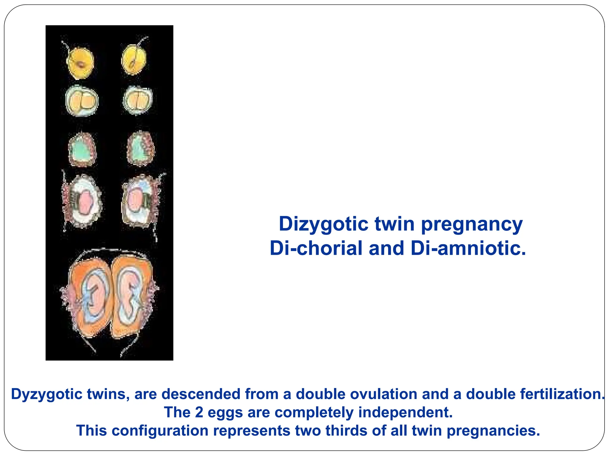 Dizygotic twin pregnancy
Di-chorial and Di-amniotic.
Dyzygotic twins, are descended from a double ovulation and a double fertilization.
The 2 eggs are completely independent.
This configuration represents two thirds of all twin pregnancies.
 