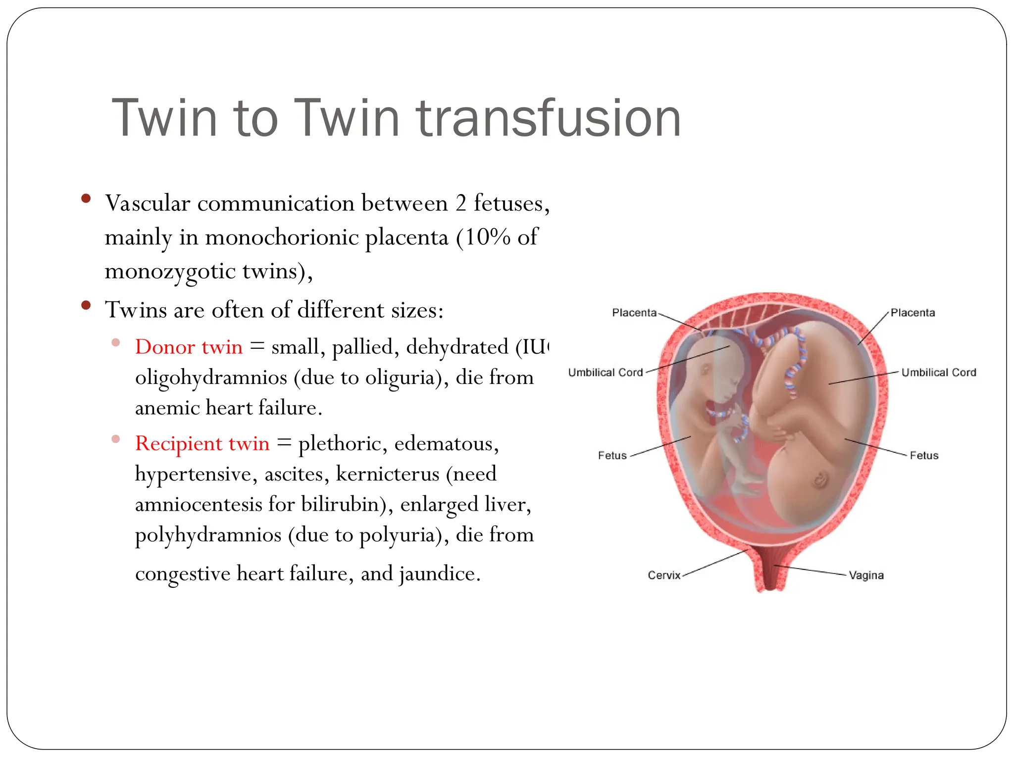 Twin to Twin transfusion
 Vascular communication between 2 fetuses,
mainly in monochorionic placenta (10% of
monozygotic twins),
 Twins are often of different sizes:
 Donor twin = small, pallied, dehydrated (IUGR),
oligohydramnios (due to oliguria), die from
anemic heart failure.
 Recipient twin = plethoric, edematous,
hypertensive, ascites, kernicterus (need
amniocentesis for bilirubin), enlarged liver,
polyhydramnios (due to polyuria), die from
congestive heart failure, and jaundice.
 