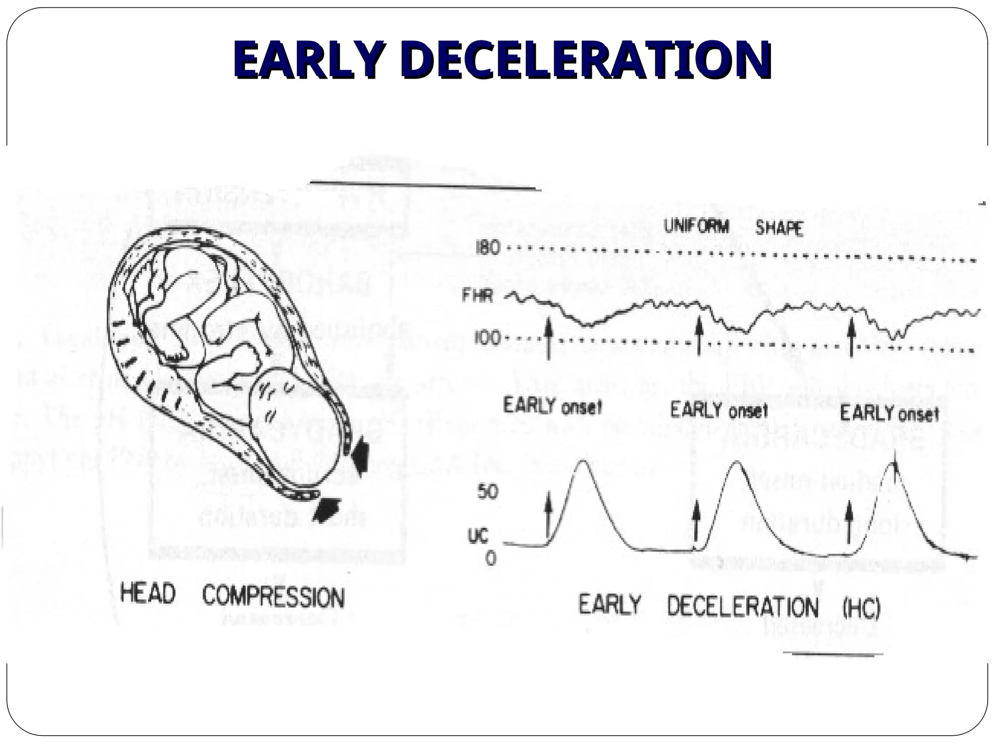 EARLY DECELERATION
EARLY DECELERATION
 