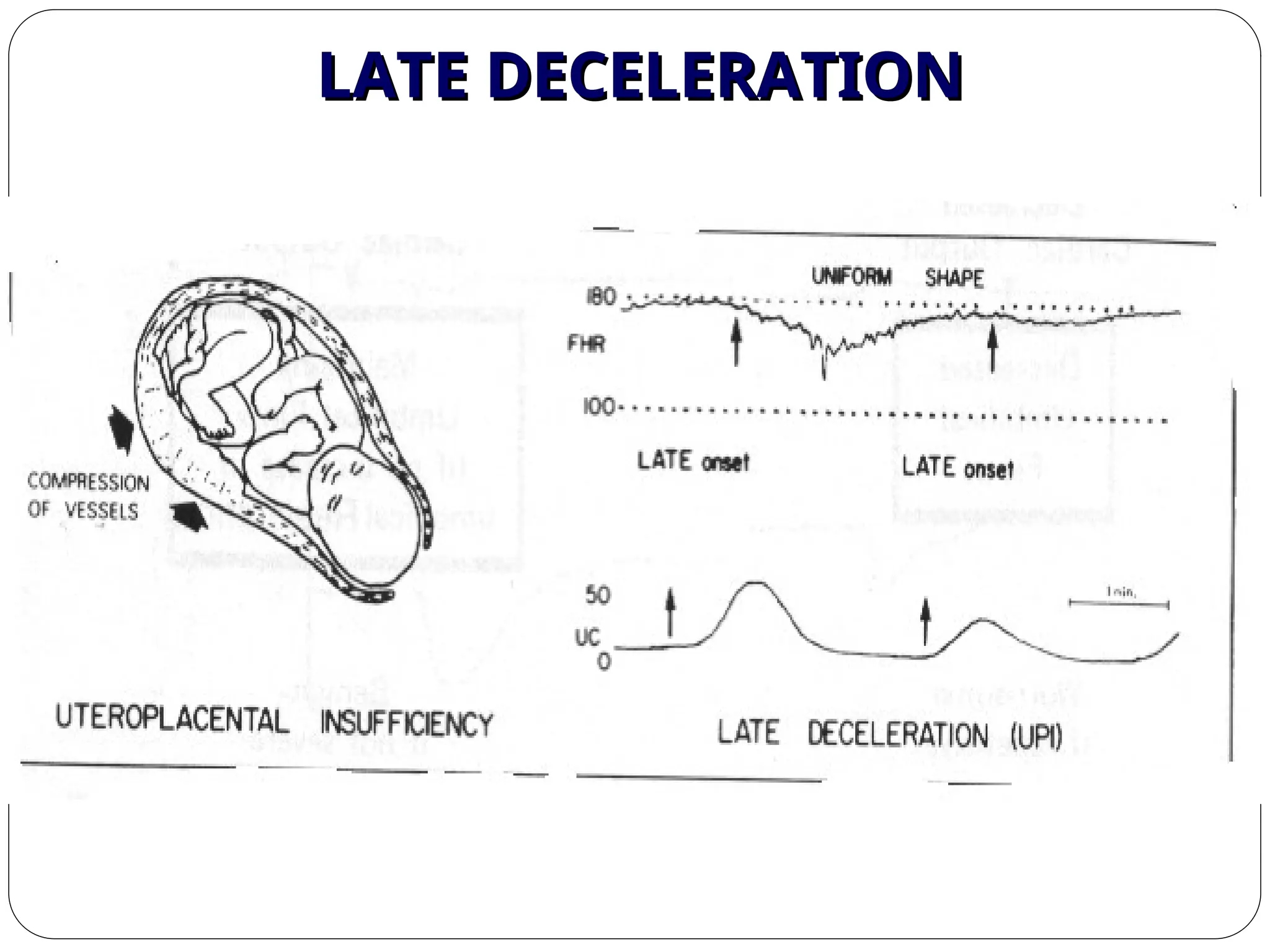 LATE DECELERATION
LATE DECELERATION
 